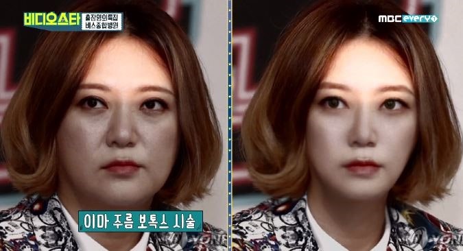   "얼굴에 레이저 쇼" 김숙, 울쎄라 600샷 고백부터 결과까지...폭발적 반응