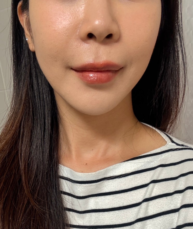  신사역 성형외과 티타늄레이저 업그레이드 트리니티 리프팅 받은 일주일차 솔직후기