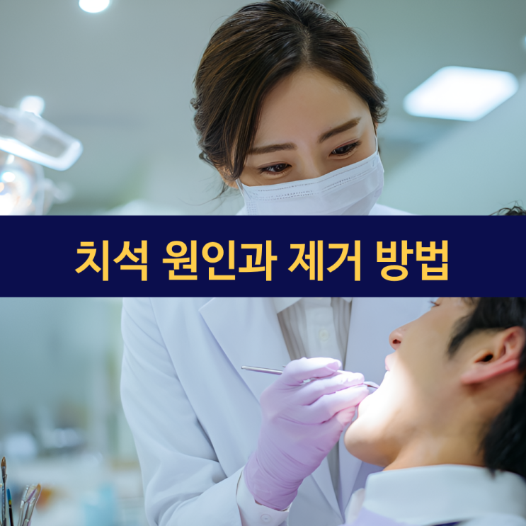  치석 생기는 원인과 제거 방법 | 치과 스케일링 효과