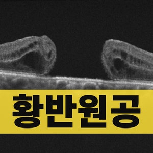 황반원공 수술 후 회복 치료 원인 증상 OCT 검사