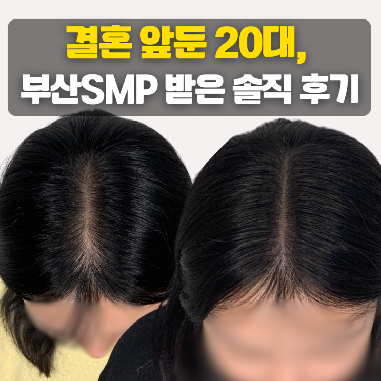  결혼 앞둔 20대, 가르마 탈모 때문에 부산SMP 받은 솔직 후기