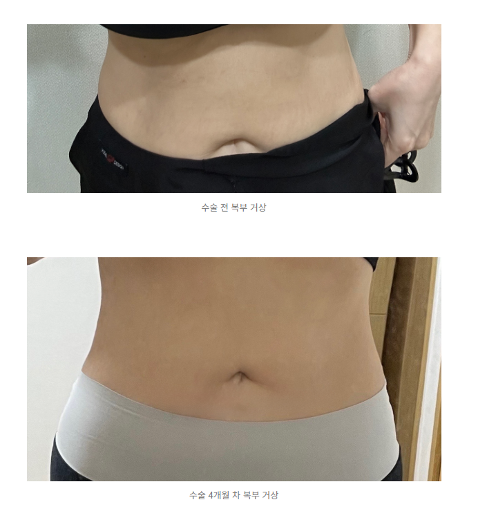  미니 복부 성형술 (mino abdominoplasty) 과 복부 지방 흡입