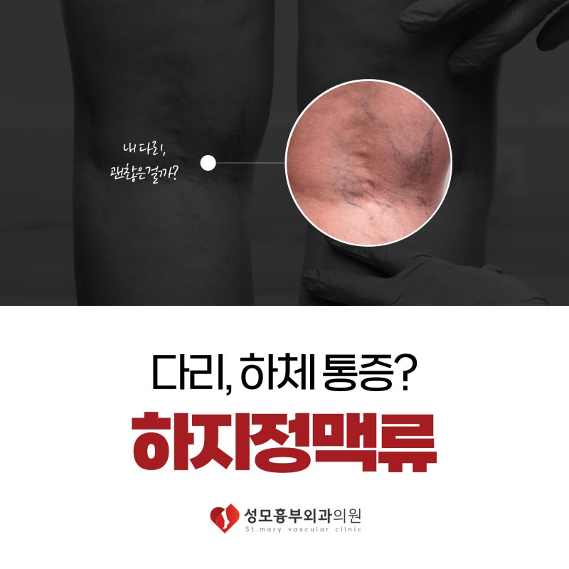 청주하지정맥류 다리피로 통증 원인이?