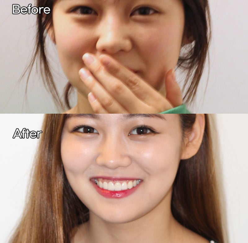 잇몸성형 가격 후기, 전후 사진 공개