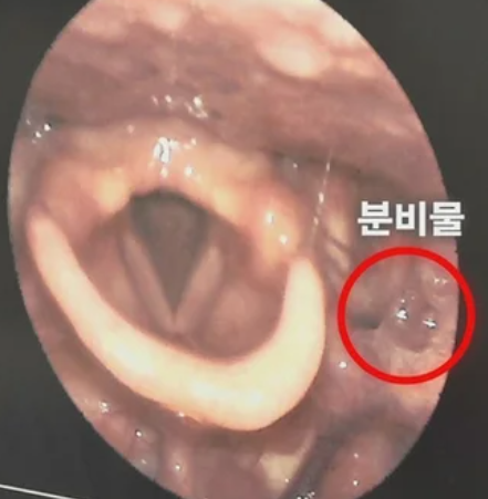병원만 전전했던 후비루염, 결국 해결책은 집 안에 있었다