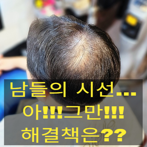  30대 남성 정수리 탈모 커버, 링거펌으로 볼륨 살린 가일컷 스타일링!