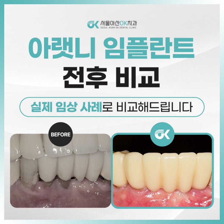  [임상사례] 하남양심치과, 아랫니 임플란트 전후 비교