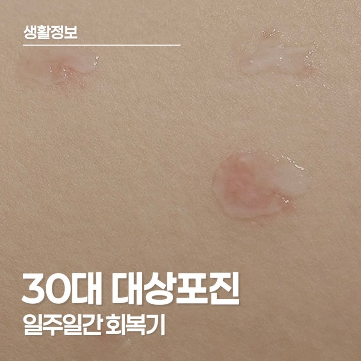  30대에 허벅지로 찾아온 대상포진, 일주일간의 기록