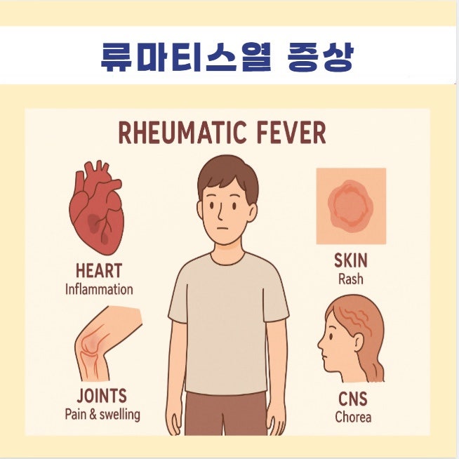 류마티스열 증상 심장 관절 피부 중추신경계 합병증 심염 판막협착 다발성관절염 윤상홍반 ....