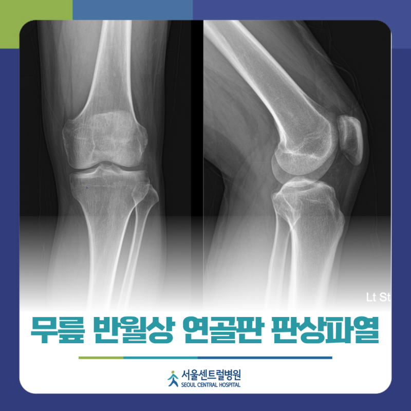 무릎 통증, 내측 반월상 연골판 판상파열일 수 있습니다