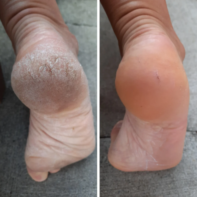 발뒷꿈치 유리 각질제거 풋필링 스크럽 풋스틱 파일 풋팩 스프레이 관리법