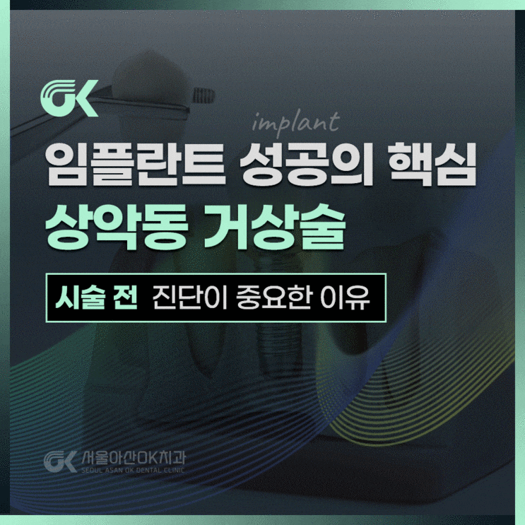  하남시치과, 상악동거상술 후 임플란트 과정