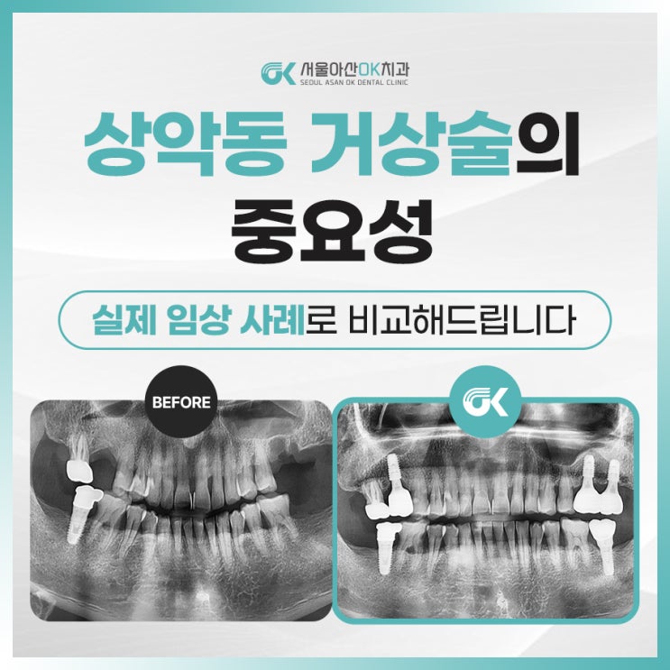  [임상사례] 미사강변치과, 상악동거상술 잘하는 곳
