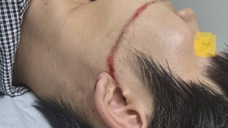 안산 <b>워터건 사고</b>, 대학생 얼굴 찢어질 정도 부상… 안전관리... 