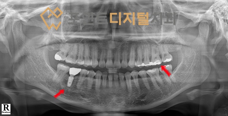  [탕정치과]  iGBR(급속골이식) + PDRN(연어주사) + 디지털 가이드 + 하이니스 디지털 보철 임플란트 / 천안 아산