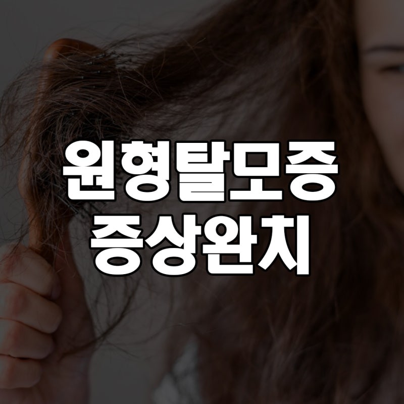 여성 원형탈모증 증상 완치까지