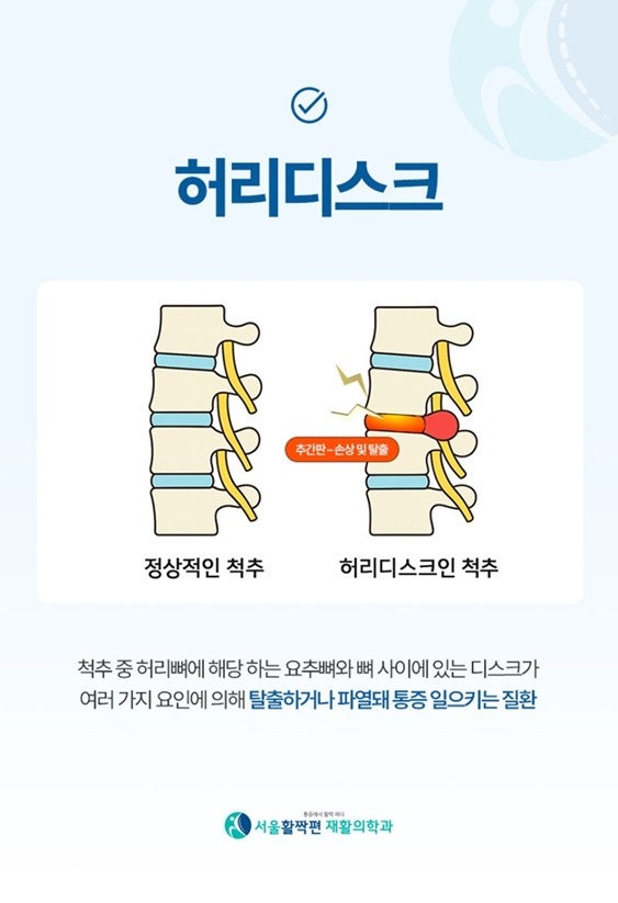 How Does It Work and What Are Its Benefits for Managing Herniated Discs? — 본문 그림