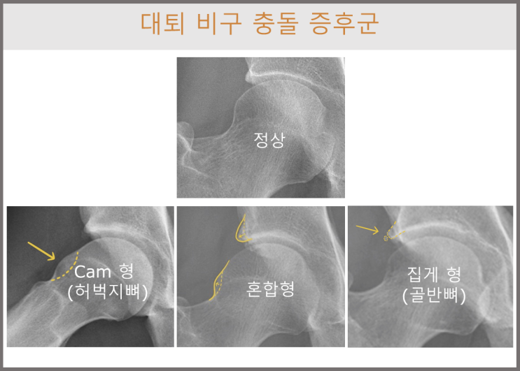  고관절 충돌증후군(Femoroacetabular Impingement, FAI)이란?