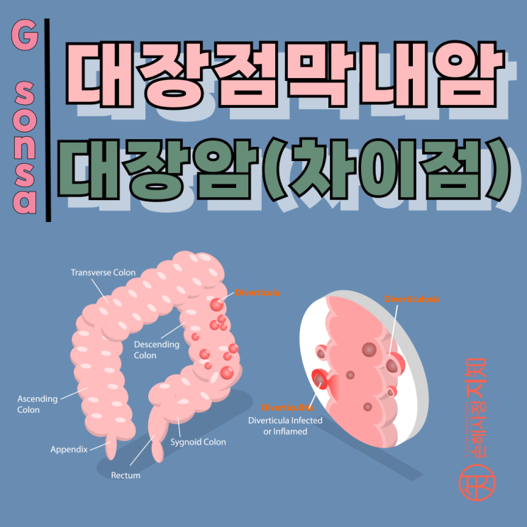  대장점막내암 대장암, 1mm 차이로 생사가 갈린다. - [의학정보, AlDa]