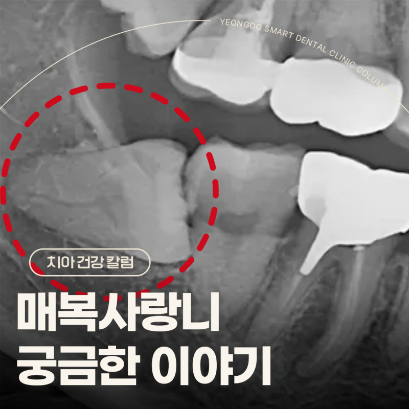 완전 매복사랑니 발치 후 구멍 관리 방법