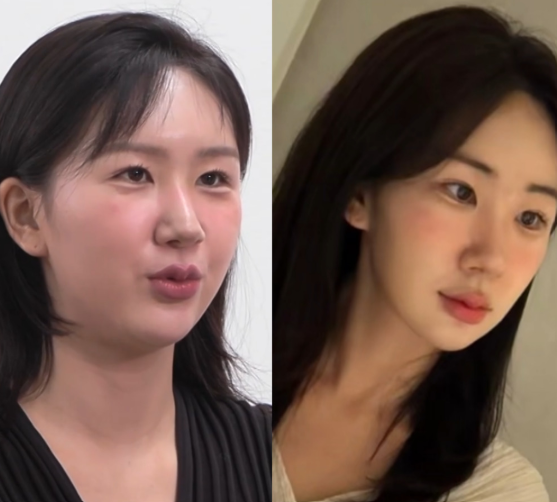  여의도 피부과 처진 얼굴이라면 올타이트 리프팅으로