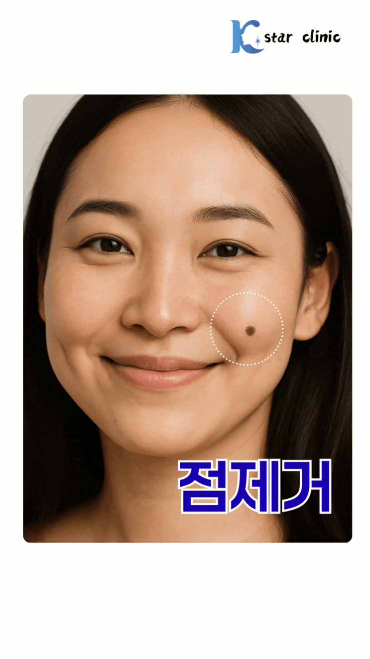  광주 점제거 아이스점빼기 빼는 곳에서 깔끔하게 제거하려면