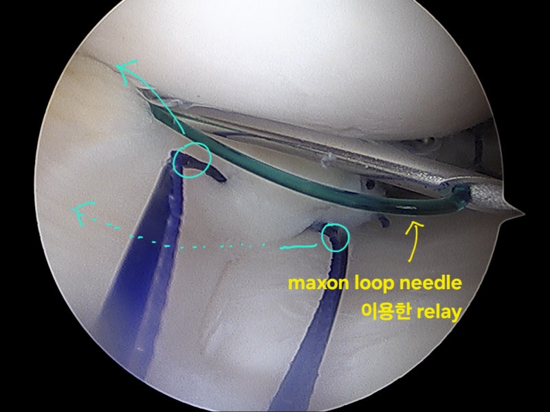 [내측 반월상 연골판 복합 파열 ; 관절경 하 봉합술] 젊은 환자분의 연골판 손상은 복원하는 ....