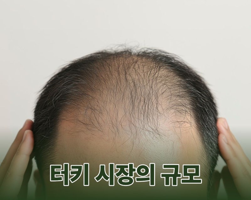 터키 모발이식 단점 적합한 유형과 기관 선택