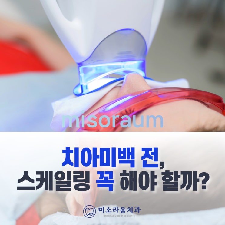  강남역 치아미백 전, 스케일링을 해야 하나요?