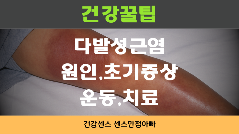 다발성근염 원인 초기 증상 및 운동 치료