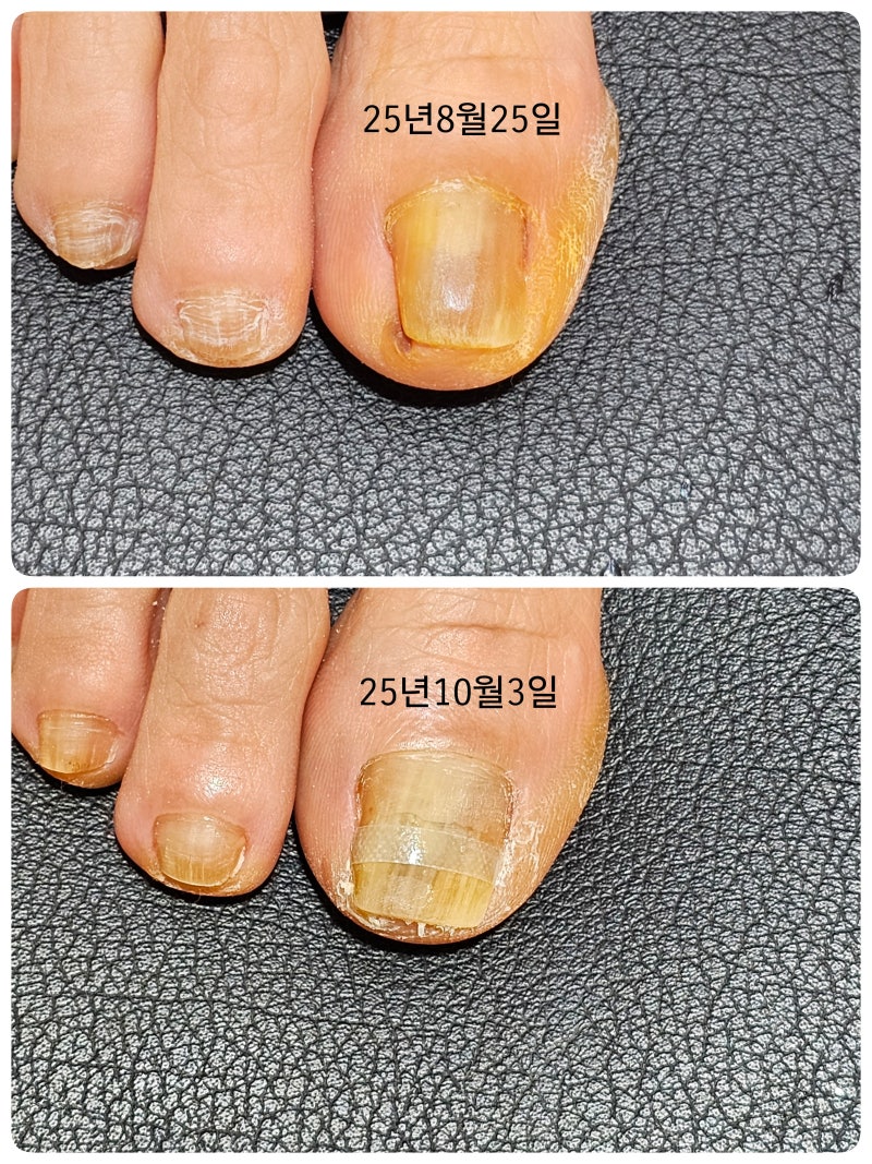 [구래동 네일샵 / 김포네일아트] 파고드는 발톱, 발톱교정, 엄지발톱 아파요, 문제성발톱, 내....