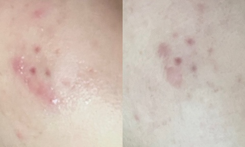  미노씬 먹고 4일만에 좁쌀여드름 없어진 후기 | 가격, 효과, 나만의 닥터 처방, 주의사항, 부작용