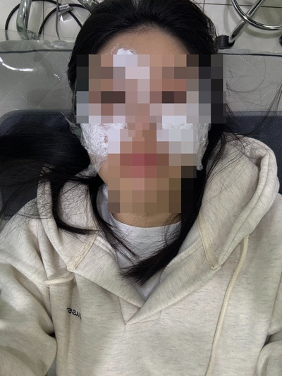  얼굴 편평사마귀 제거 후기 시작 feat. 레이저, 프로폴리스 내돈내산