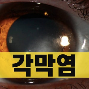 헤르페스 각막염 증상 치료기간, 대상포진 각막염