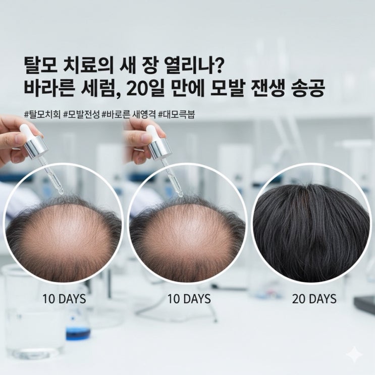  "바르는 탈모 치료제 나온다" 大만 연구진, 모낭 재생 세럼 개발 성공