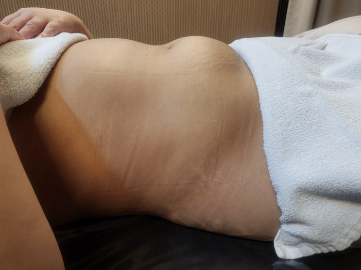 지방흡입 후 통증이 오래간다면?
