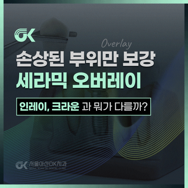  하남보철치료, 세라믹 오버레이란?
