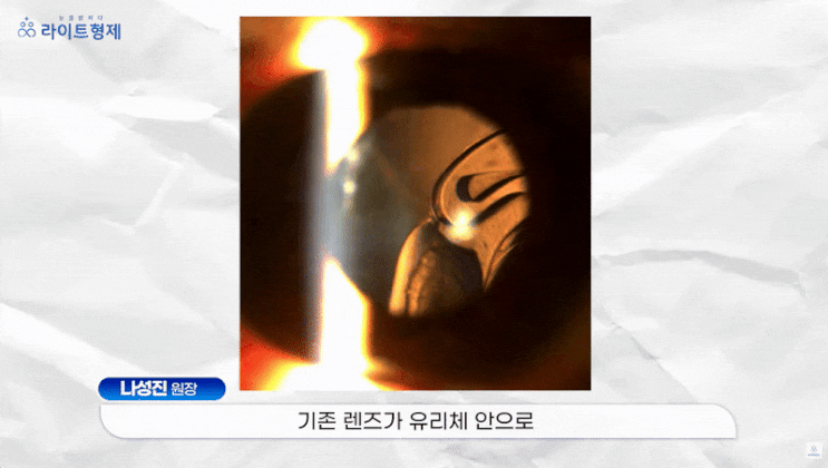  공막고정술, 라식 25년 후 인공수정체 탈구 해결 사례