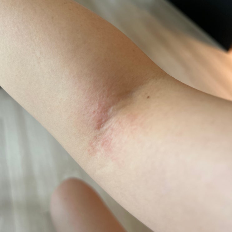  염증에 안좋은 음식 줄였는데 피로하다면 40대 몸속염증제거 영양제로 컨디션 챙기기