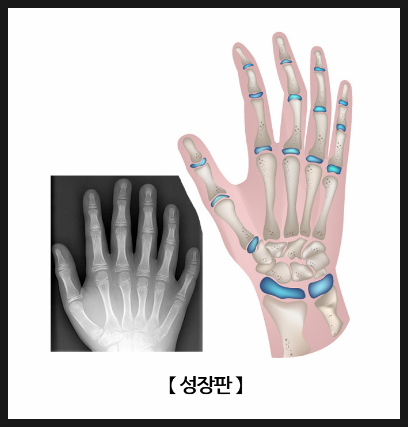 울산 아동교정 성장판 검사로 타이밍 잡는 법