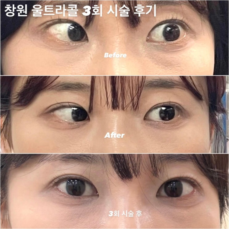  창원 울트라콜 콜라겐 눈밑 시술 3회 후기 부작용 통증