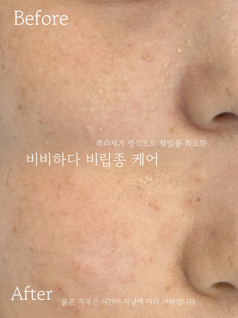 김포 비립종 제거 잘하는 곳 뿌리 제거로 재발률 최소화 3초 컷 제거 추천