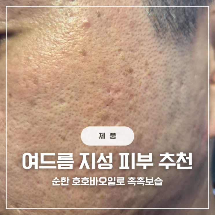  여드름 민감성 지성 피부 건조한 계절엔 트러블 없는 올리브영 호호바오일