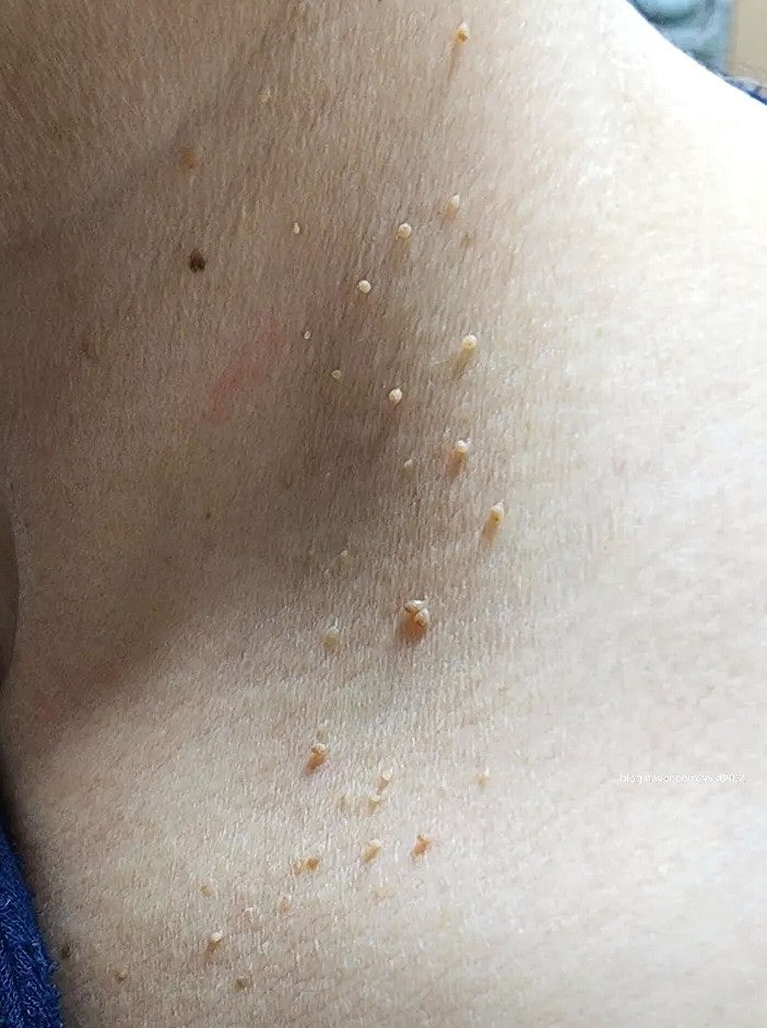발을 씻자 풋 샴푸로 쥐젖 제거 후기 기록 (개인차 있음)
