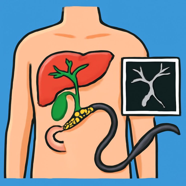  담관 결석 원인 증상 , 총담관, ERCP, MRCP 검사 방법