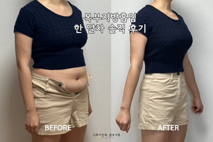  복부지방흡입 한달 솔직 후기 (붓기, 부작용, 멍, 바본, 과정 총 정리)