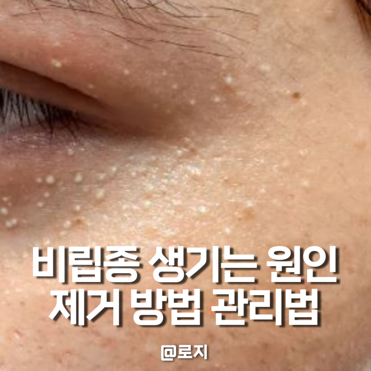  얼굴 비립종 생기는 원인 제거 예방 생활습관 관리 방법
