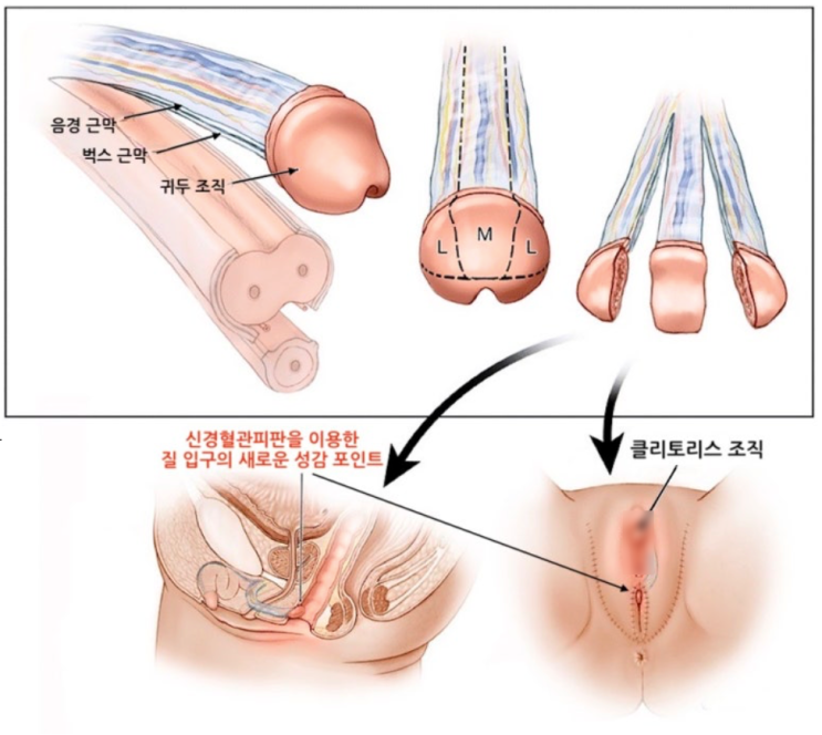  태국 성전환 수술 차이 - 질 내부 성감 구축까지 가능한 ‘신경 재건’ 기법
