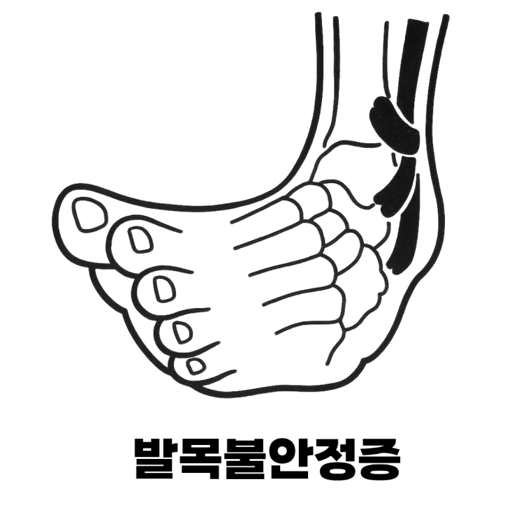  발목염좌 자주 겪는다면? 발목불안증 신호일 수 있어요