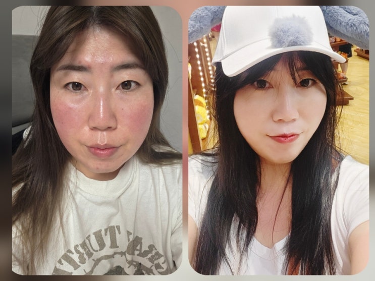  바노바기의원 창원 인모드 FX모드 레이저 리프팅 ! 처진볼살, 이중턱고민! 시술 솔직 후기!